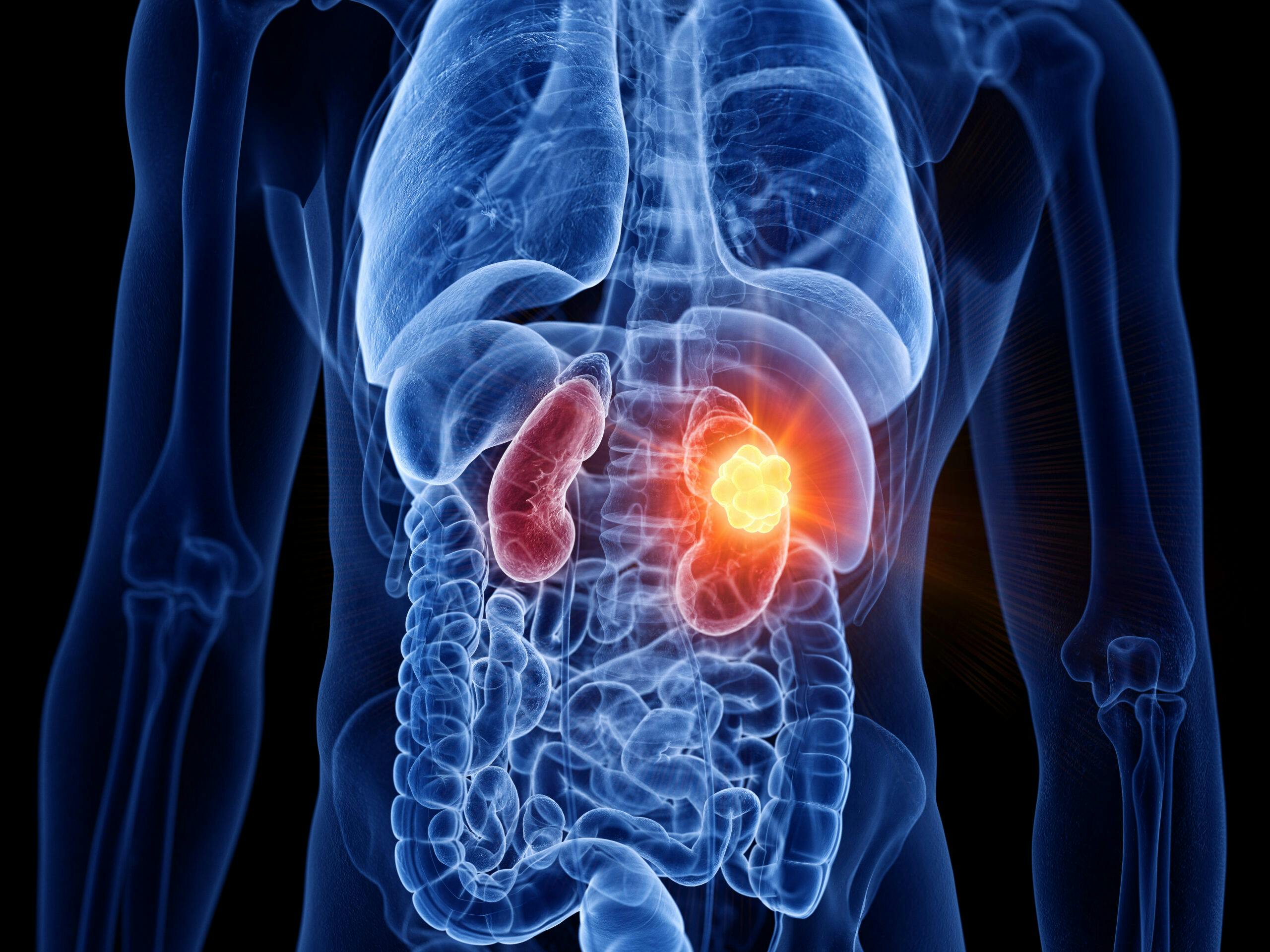 3d,Rendered,Medically,Accurate,Illustration,Of,Kidney,Cancer
