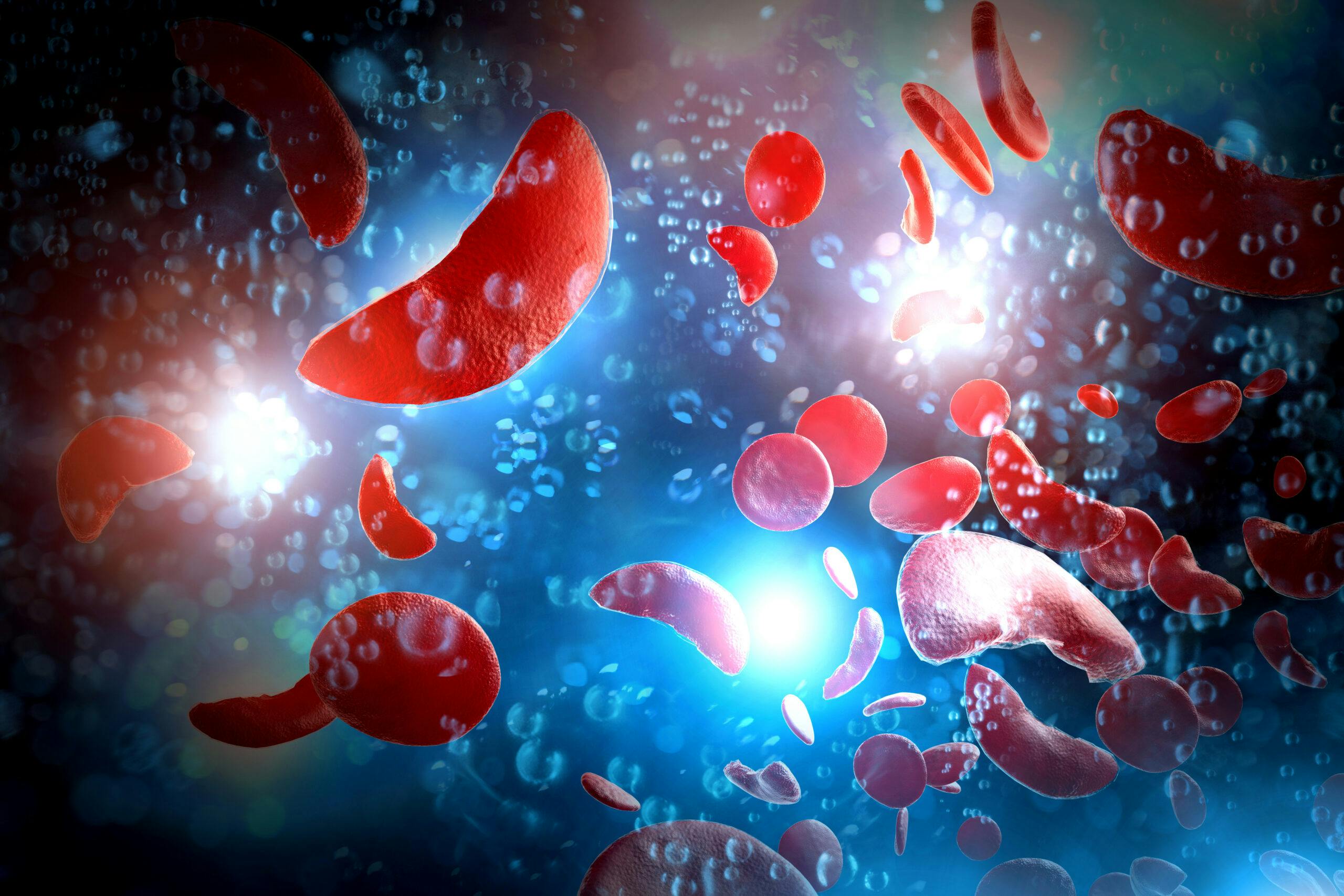 Sickle,Cell,Anemia,Disease,(scd),Blood,Cells,3d,Illustration
