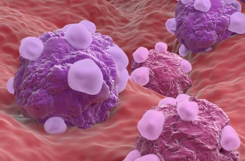 Ovarian Cancer Cells
