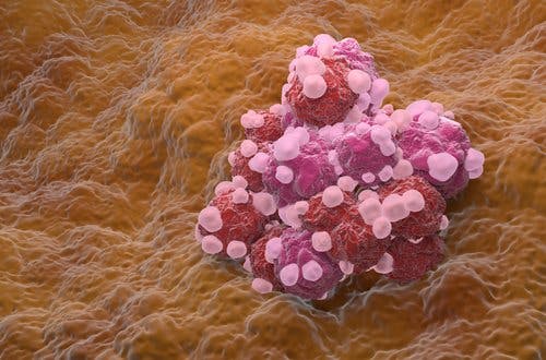 Ovarian Cancer Cluster
